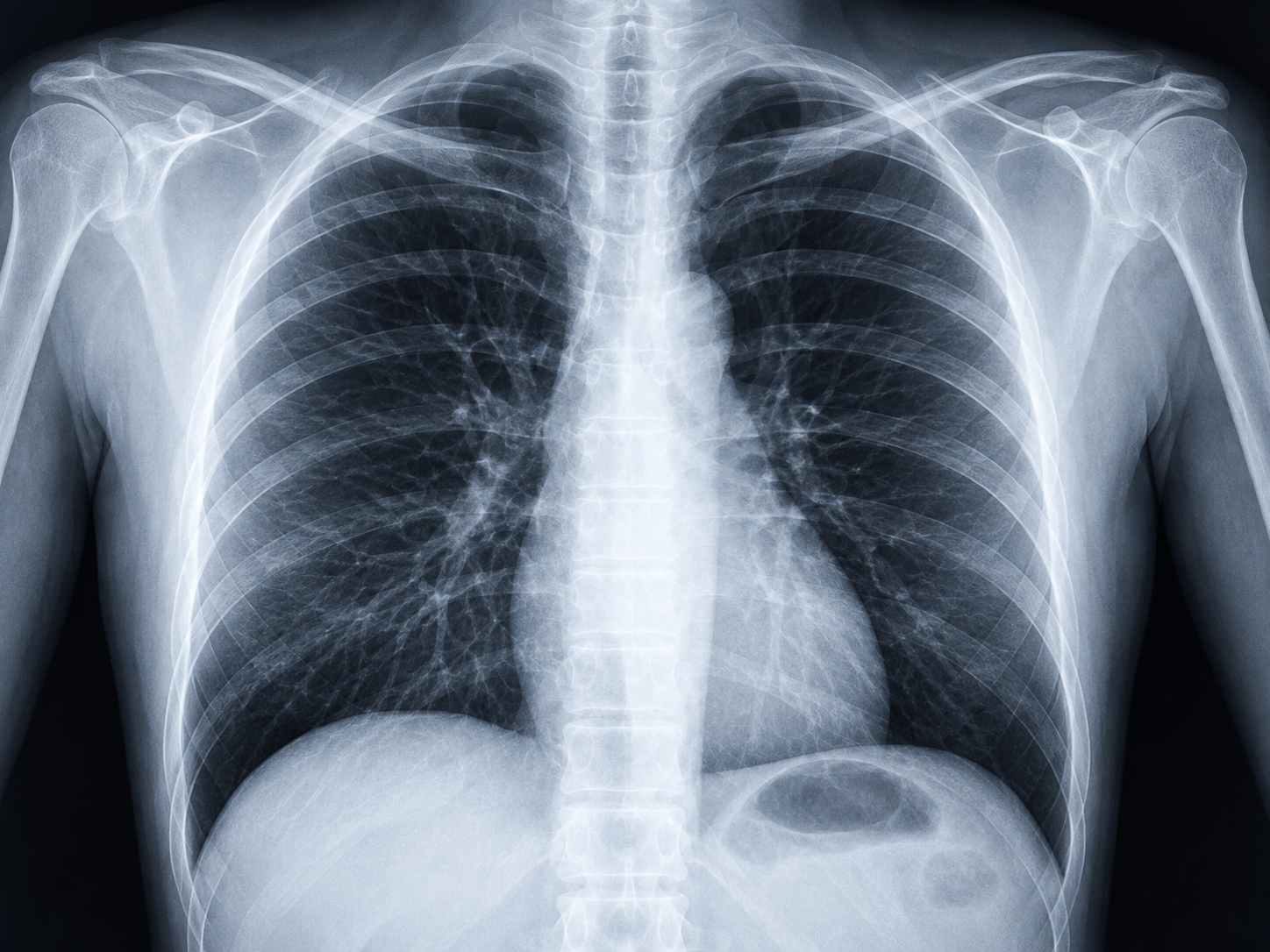 Digital chest X-ray
